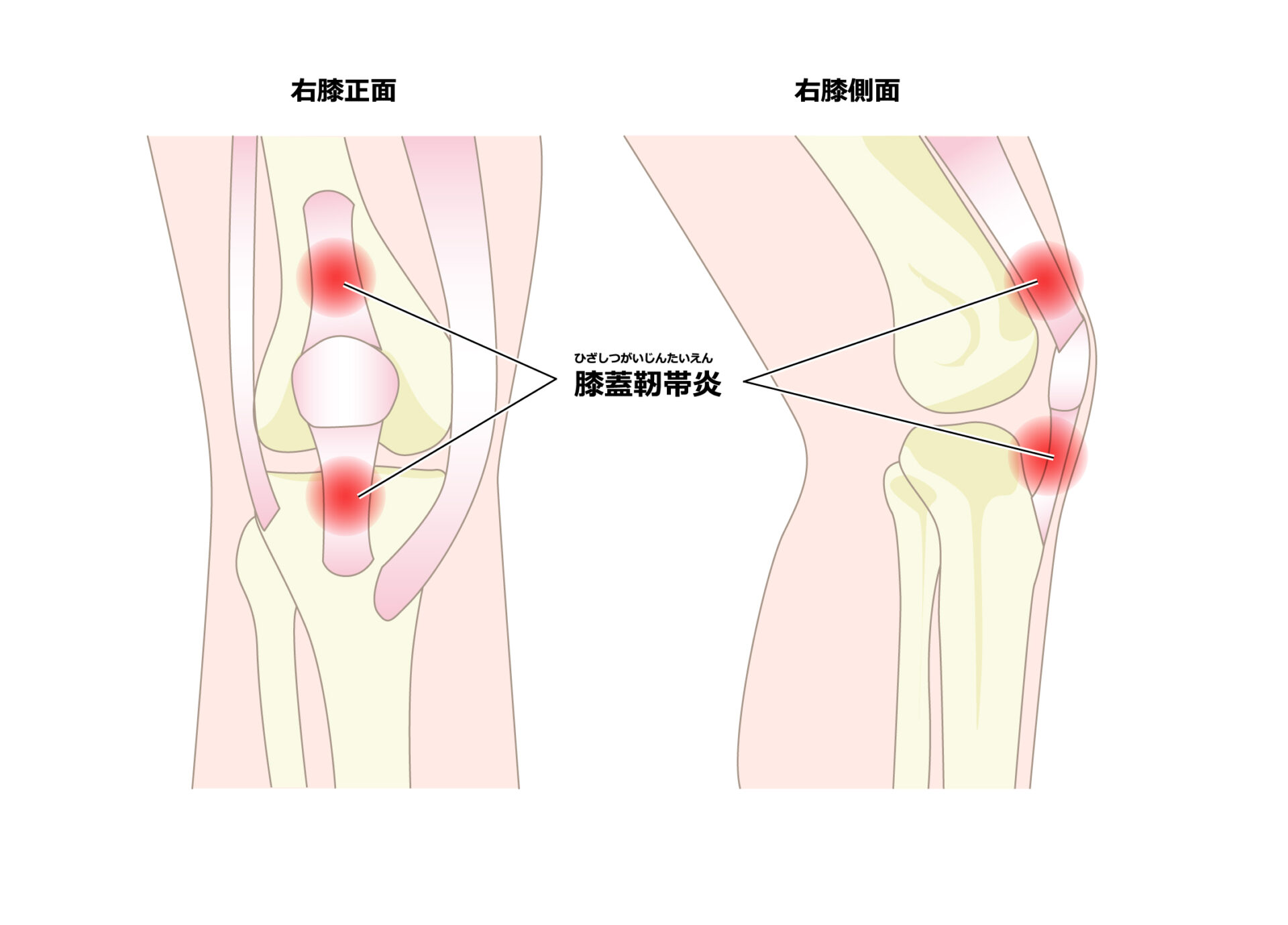 膝蓋靭帯炎の画像