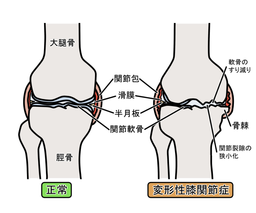 変形性膝関節症の画像