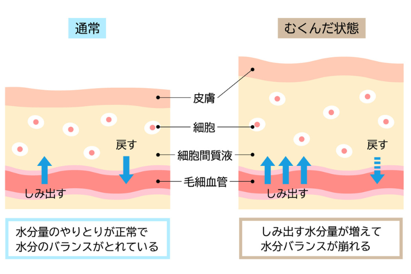 浮腫みの仕組み